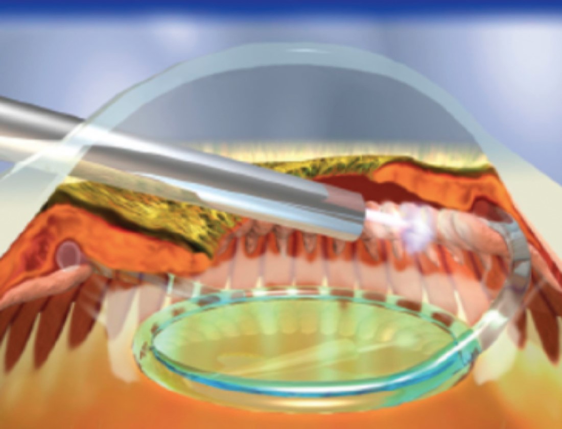 Endoscopic Cyclophotocoagulation