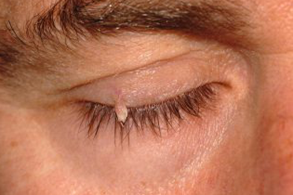 Pyoderma Eyelid Squamous Papilloma Eyelid Eyelid Lesions For Medical Students أ.د.