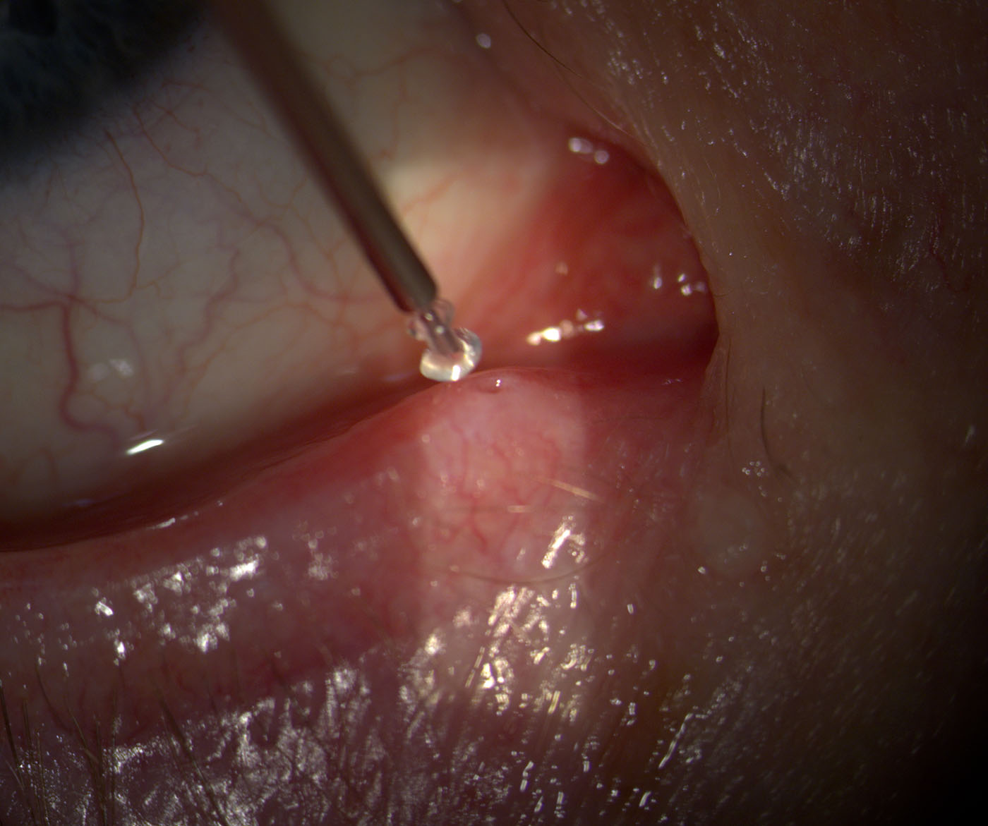 Punctal Plugs for Dry Eye: A Comprehensive Guide