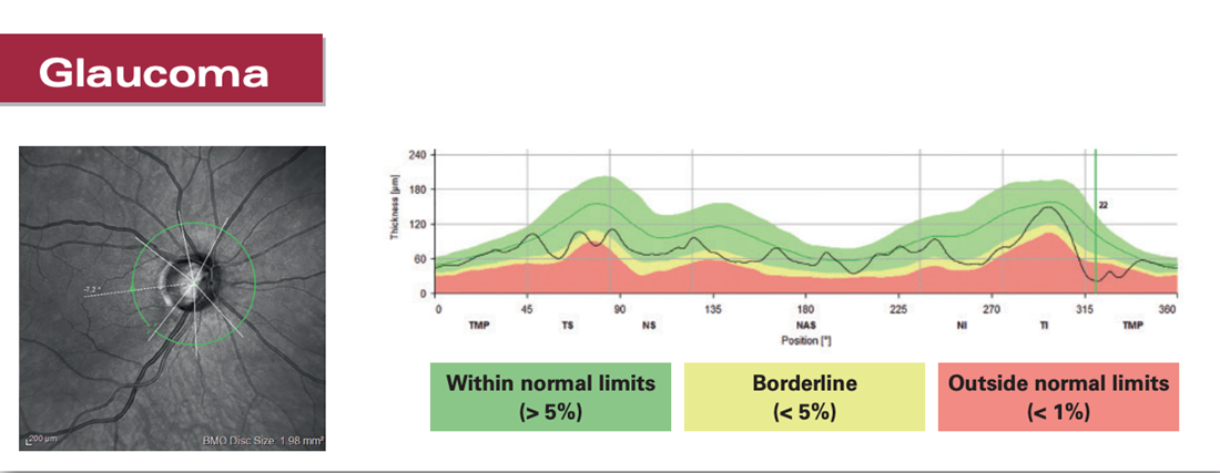 Glaucoma OCT