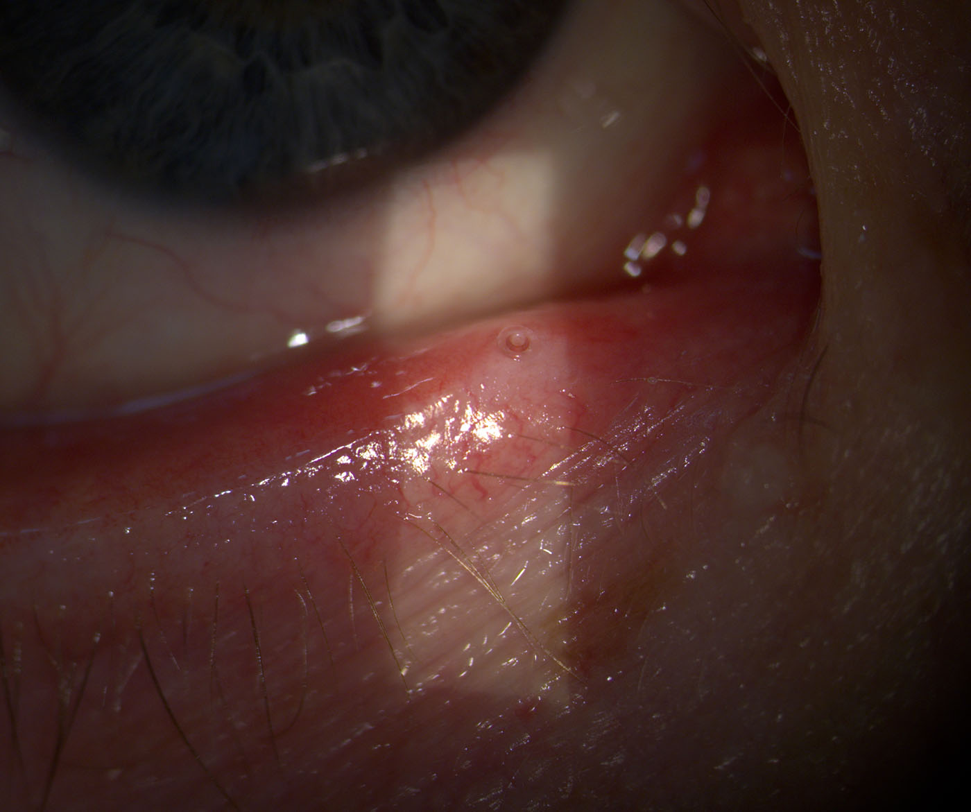 Punctual plug in situ