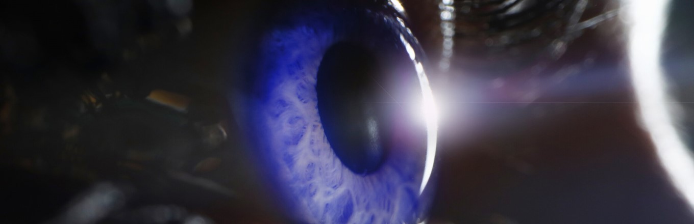 YAG laser peripheral iridotomy