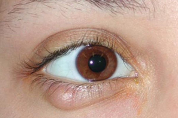 Chalazion And Styes