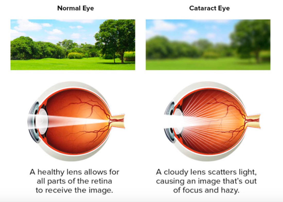 Cataract Vision Comparison
