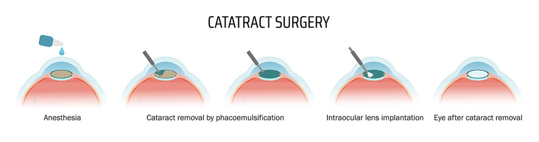 Cataract Surgery Diagram