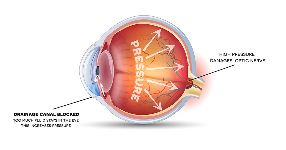 Glaucoma Diagram