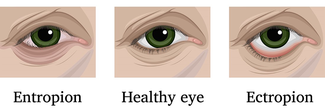 Entropion Ectropion Diagram