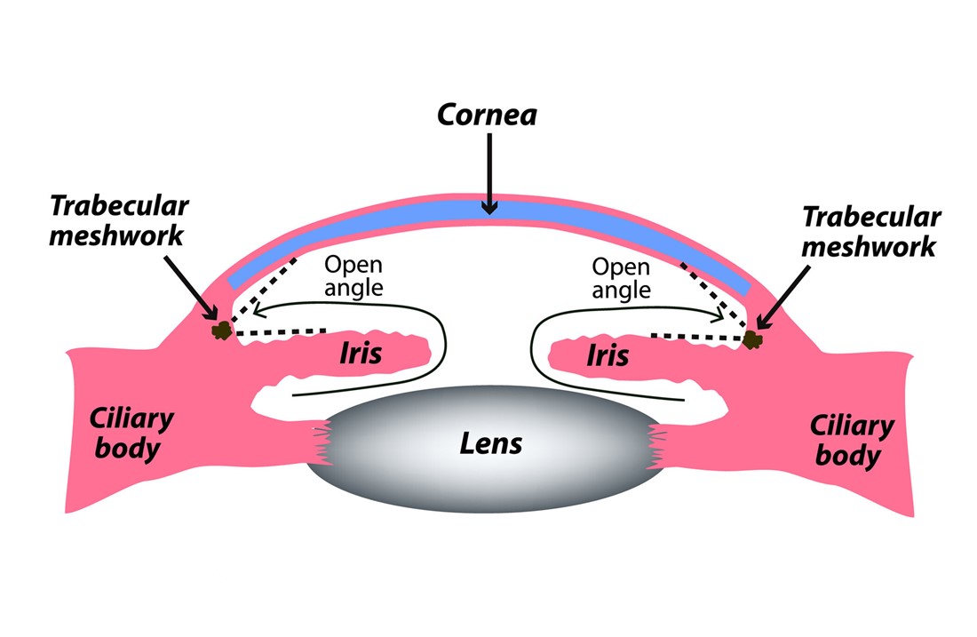 Open Angle Glaucoma Diagram